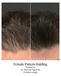 Calecim Hair Serum 5ml bottle for scalp treatment, part of 6-week hair restoration program with PTT-6®.