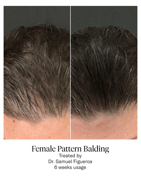 Calecim Hair Serum 5ml bottle for scalp treatment, part of 6-week hair restoration program with PTT-6®.
